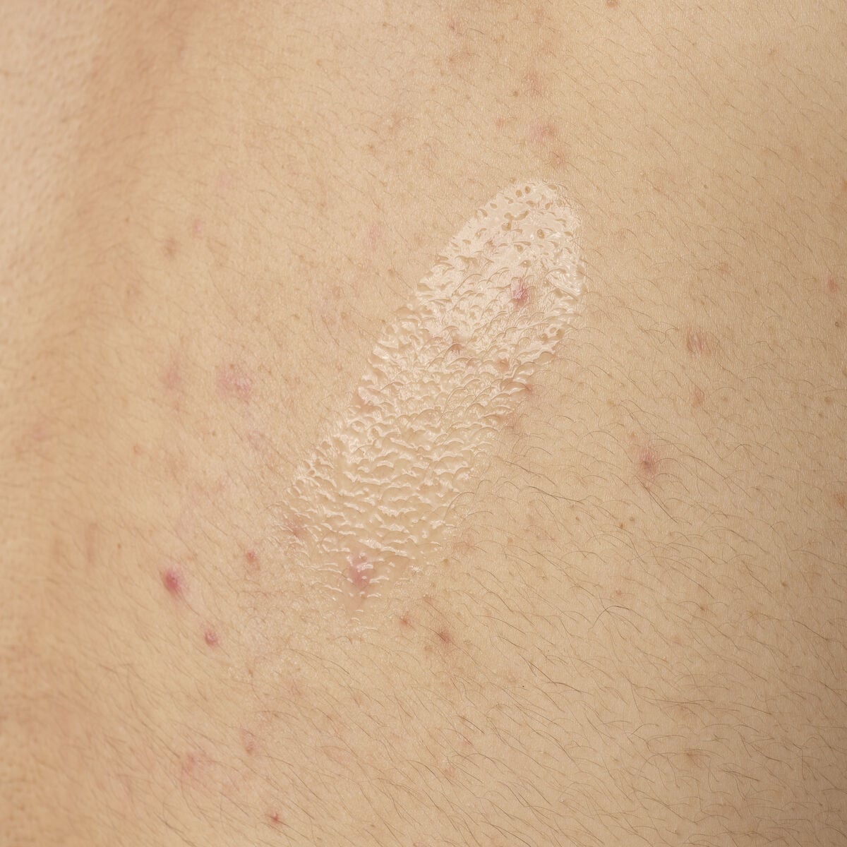 salicylic-acid-0-5-body-serum-q1 ORD-salicylic-acid-05-body-240ml-application.jpg