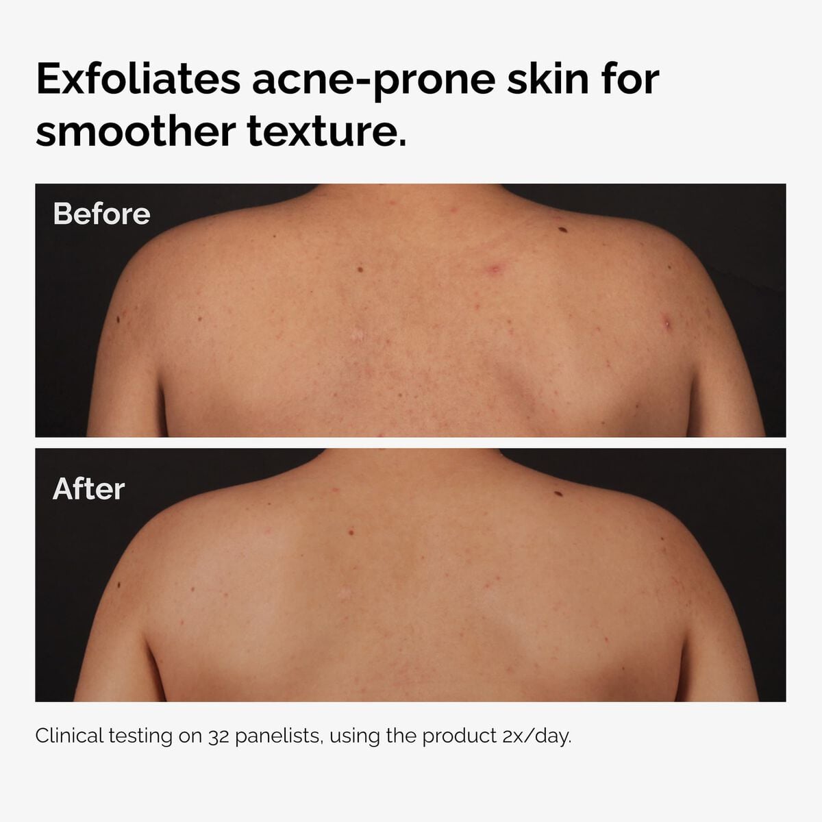 salicylic-acid-0-5-body-serum-q1 ord-salicylic-acid-body-serum-before-after-graphic-NA.jpg
