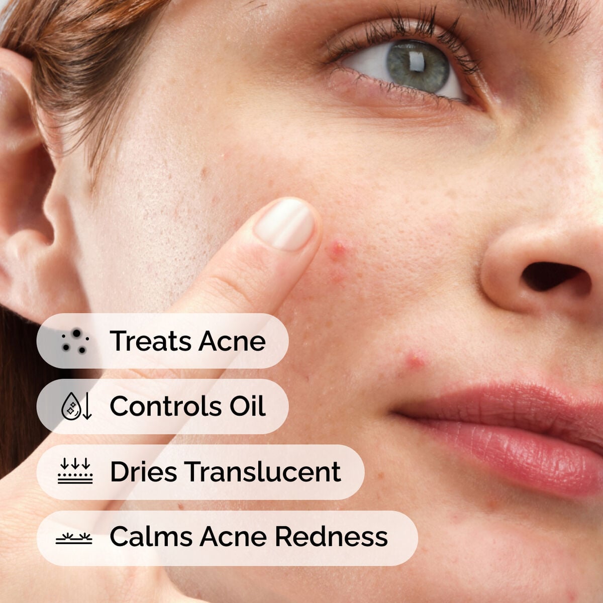 sulfur-10-powder-to-cream-concentrate-z6 ord-sulfur-10pct-powder-to-cream-concentrate-model-application-with-benefits-acne.jpg