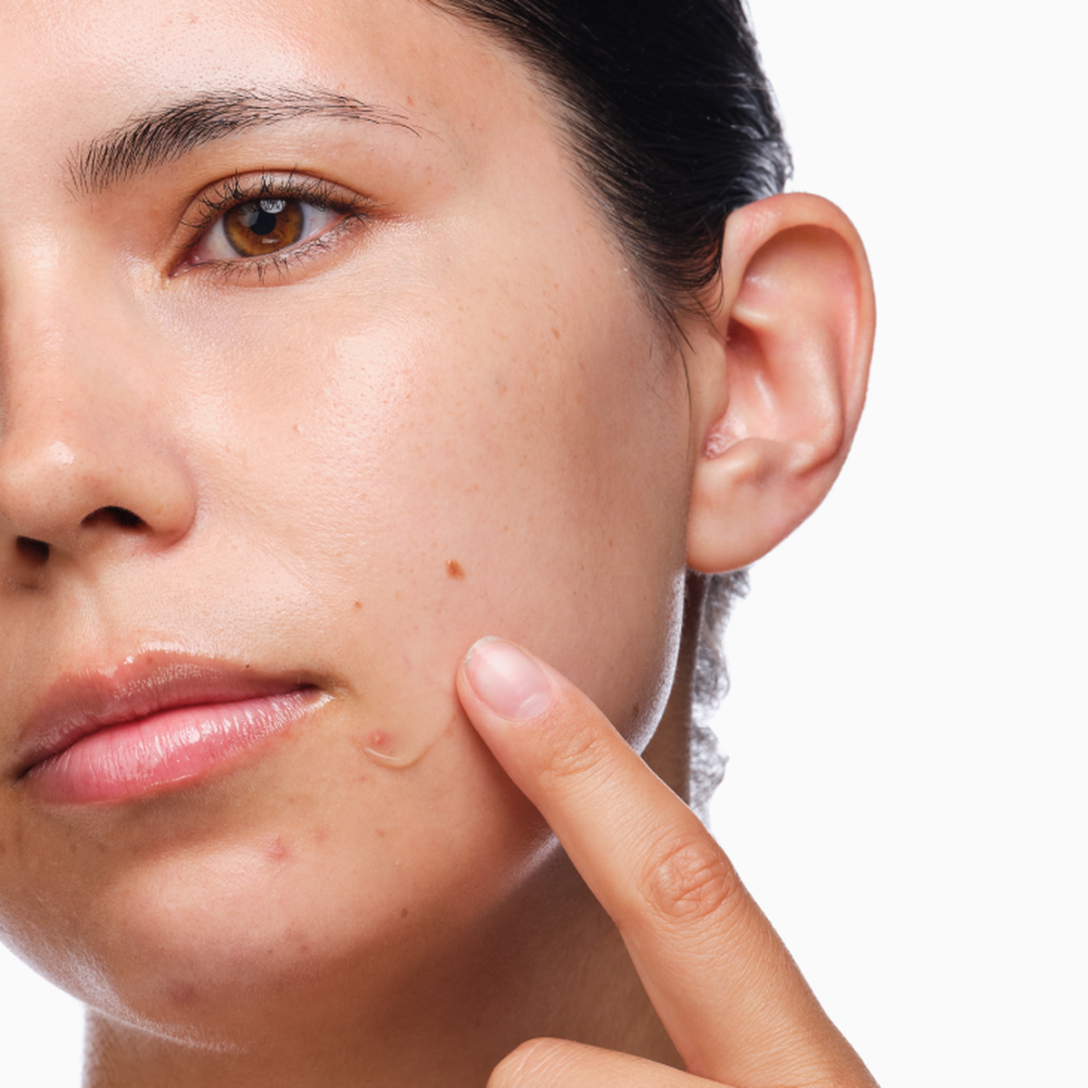 the-acne-set-z2 rdn-the-acne-set-application.png